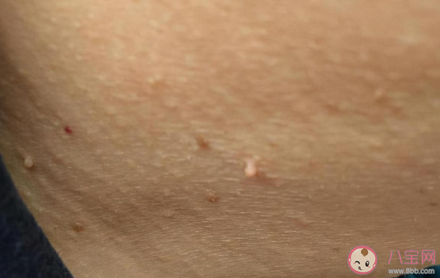 丝状疣需要治疗吗 丝状疣跟女性宫颈HPV有关系吗