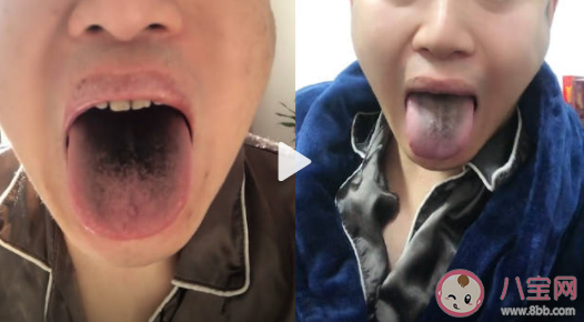 男子确诊后舌头牙齿全变黑是怎么回事 确诊新冠舌头会变黑吗