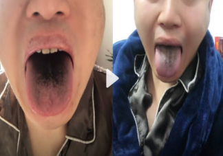 男子确诊后舌头牙齿全变黑是怎么回事 确诊新冠舌头会变黑吗