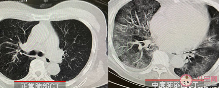感染新冠会变白肺吗 阳后有必要拍肺部CT吗