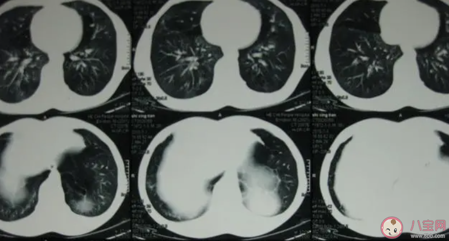 阳后有必要拍肺部CT吗 阳后怎样判断肺部有没有问题