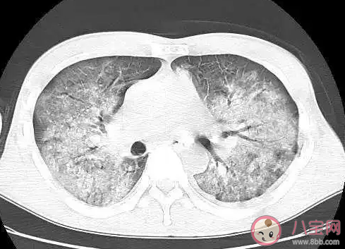 白肺是什么 白肺的症状有哪些