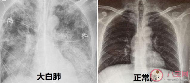 3个办法可提前预警白肺是什么 有肺炎就是白肺吗