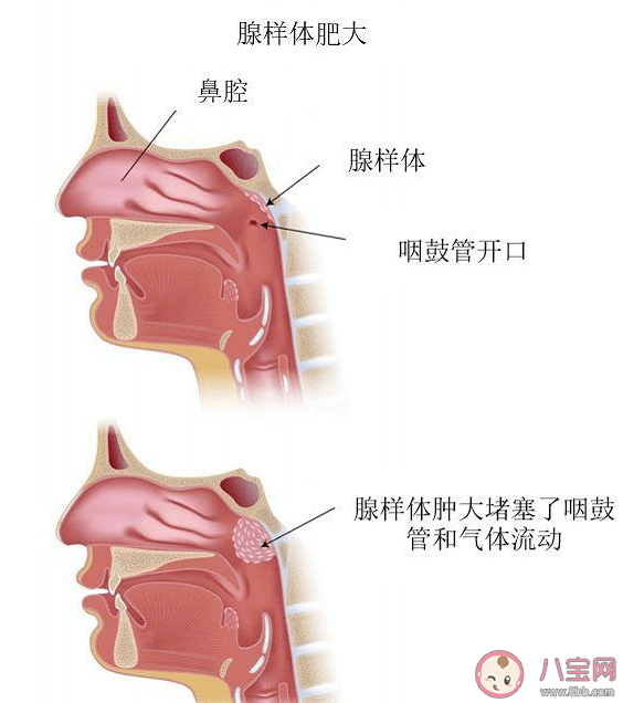 腺样体肥大哪些情况需要就医 腺样体肥大切除术黄金时期是几岁