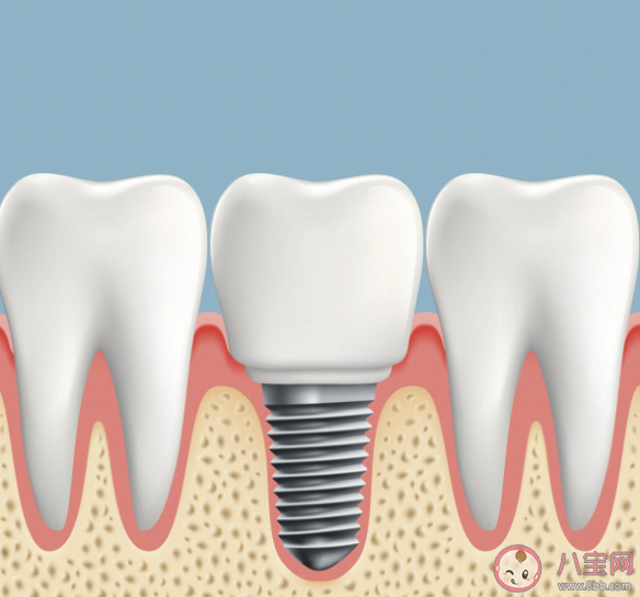 怎样提高国产种植牙使用率 关于种牙你了解多少