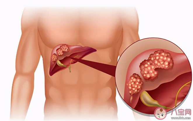 为什么肝癌通常一发现就是晚期 肝癌遗传几率大吗