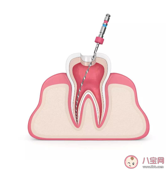 杀死牙神经后牙还能活多久 根管治疗有什么好处
