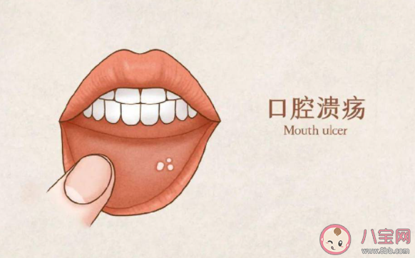 口腔反复溃疡病根不一定在嘴 口腔溃疡反反复复怎么办