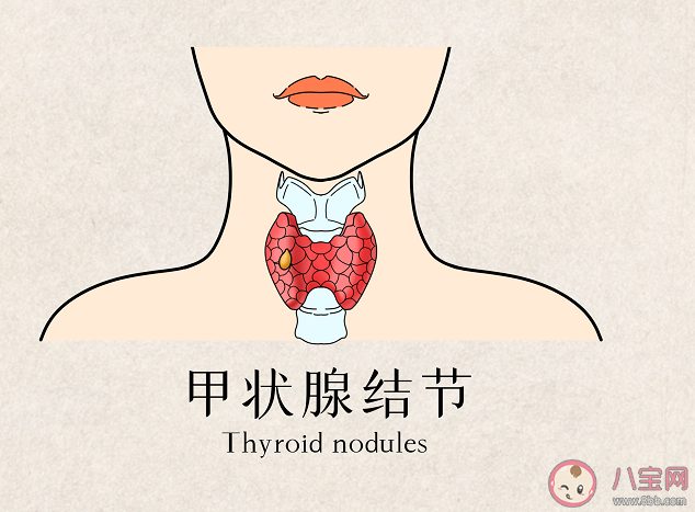 甲状腺结节发生率在20%以上 甲状腺手术怎么选择