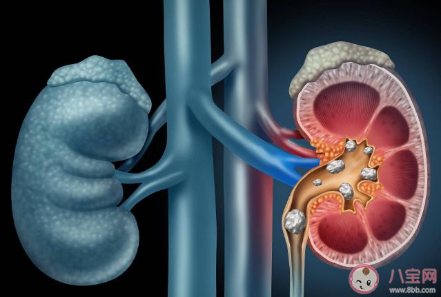 肾结石痛仅次于顺产分娩吗 肾结石不痛更危险吗