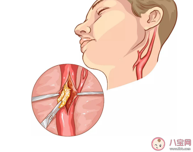 体检发现颈动脉斑块严重吗 长了颈动脉斑块怎么办