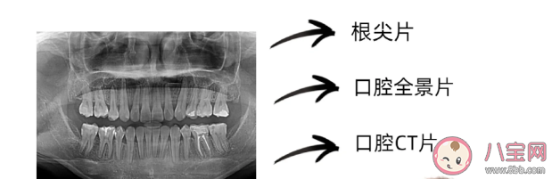 看牙为什么要拍片 口腔科中的拍片类型包括哪些