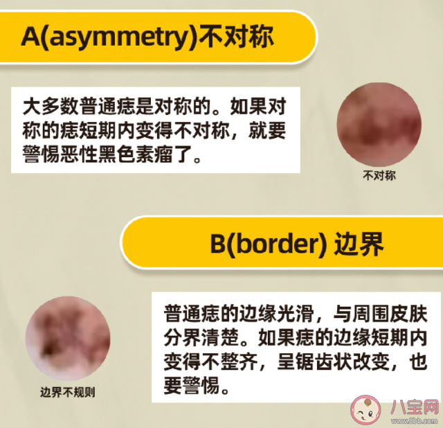 部分黑色素瘤与原发痣有关吗 什么样的痣会恶变成黑色素瘤