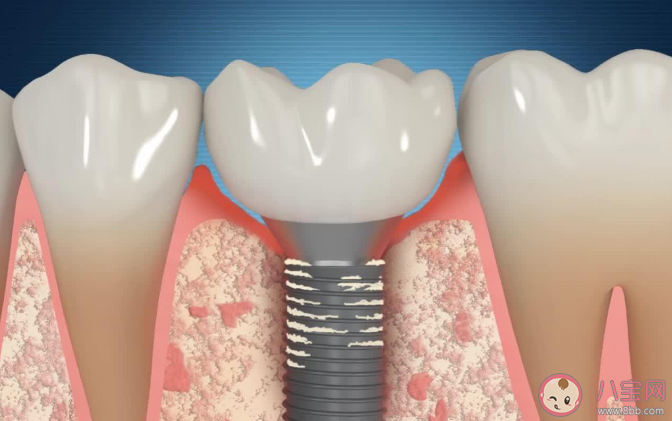 种植牙使用寿命为什么相差这么大 种植牙与天然牙有何不同