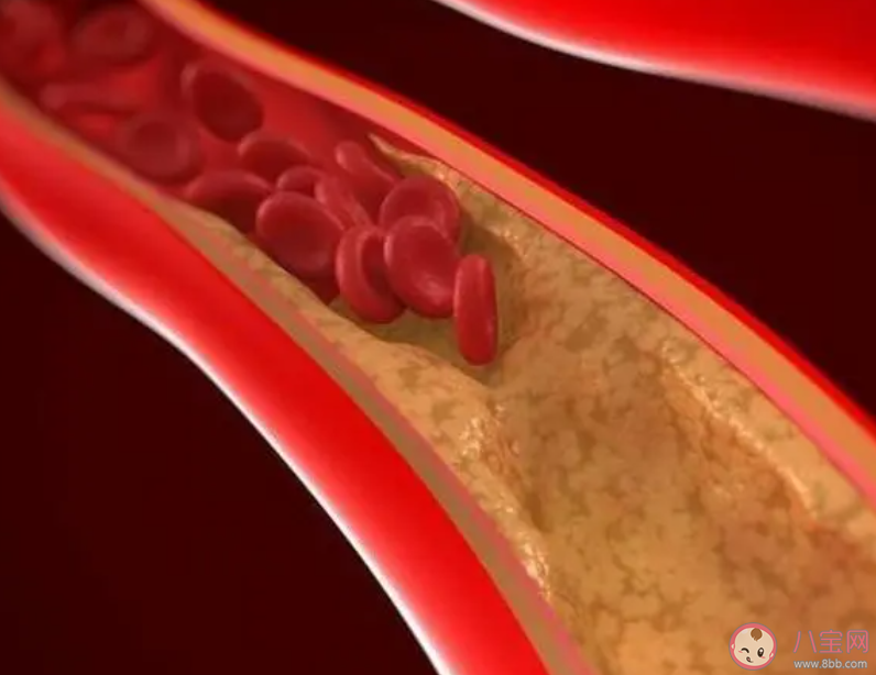 血管堵塞是什么原因造成的 如何预防血管堵塞