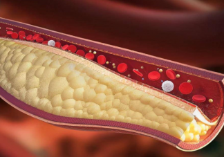 血管堵塞是什么原因造成的 如何预防血管堵塞