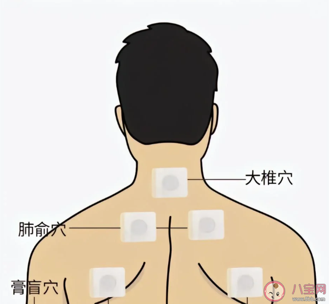 哪些体质适合三伏贴2023 三伏贴为什么要去专门医疗机构