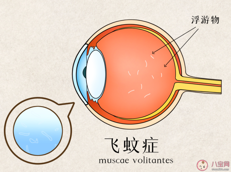 得了飞蚊症是怎样一种感觉 飞蚊症应该怎样治疗