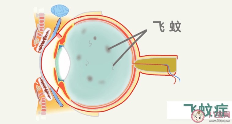 得了飞蚊症是怎样一种感觉 飞蚊症应该怎样治疗