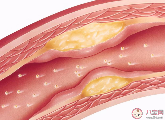 6种食物易导致动脉粥样斑块 动脉粥样硬化形成主要经过哪几步