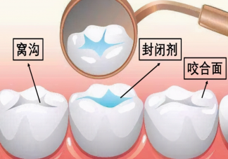 什么时候给宝宝做窝沟封闭最好 宝宝为什么要做窝沟封闭