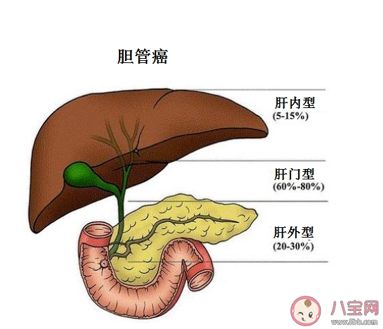 胆管癌是什么原因导致的 胆管癌能治好吗