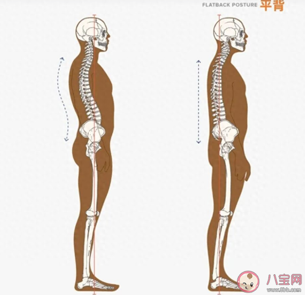 背部太直可能是平背综合征 平背有什么后果