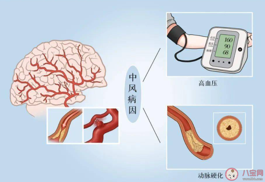 卒中高发人群包含哪些 如何预防卒中