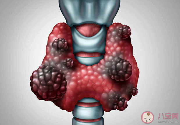 为什么甲状腺癌会盯上年轻人 导致甲状腺癌的原因有哪些