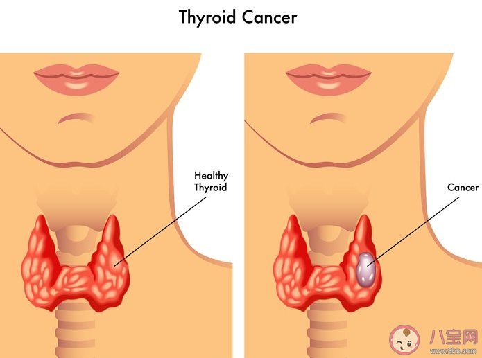 为什么甲状腺癌会盯上年轻人 导致甲状腺癌的原因有哪些