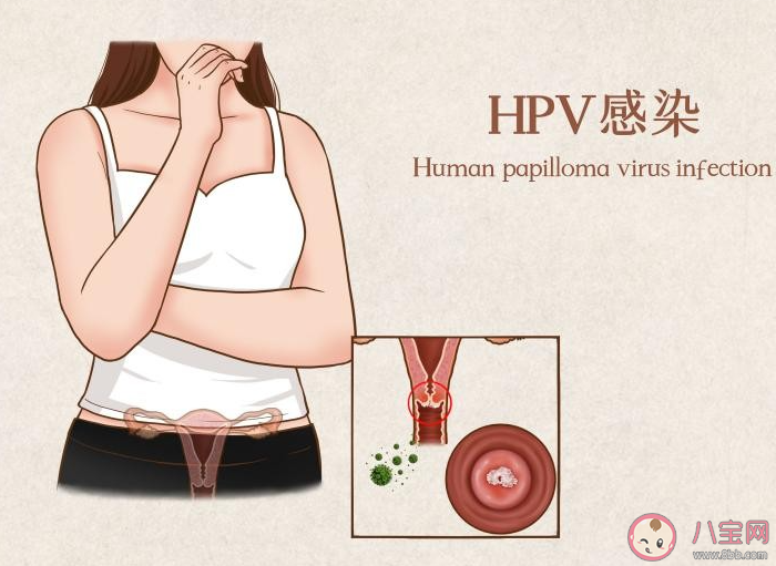 男性终身感染HPV的几率达90% 男性如何预防HPV