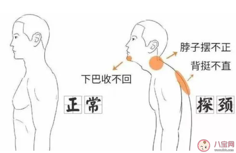 手指推下巴有助改善乌龟颈吗 乌龟颈是什么原因导致的