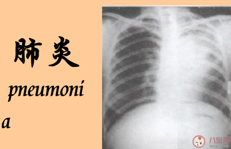 行走性肺炎今年有何不同 行走性肺炎怎么治疗