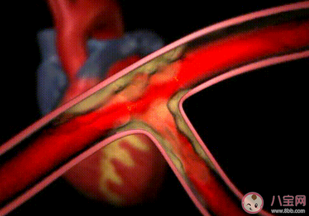 如何知道血管里有没有斑块 血管中哪种斑块更有希望逆转