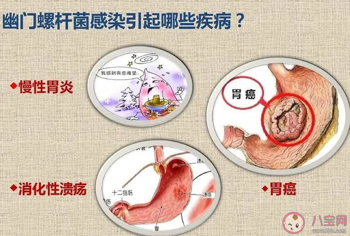 幽门螺杆菌为啥是致癌物 如何预防幽门螺杆菌感染