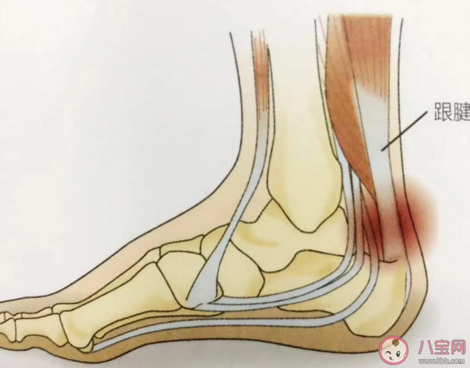 运动时如何预防跟腱损伤 跟腱断裂该怎么办