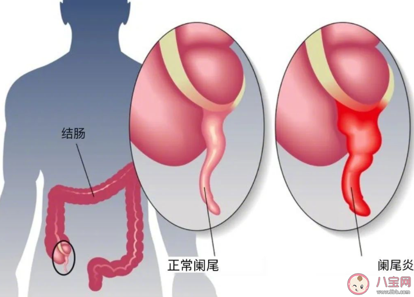 阑尾长了肿瘤就是阑尾癌吗 哪些人更容易得阑尾癌